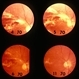 Healing of retinal lesions associated with Retinitis